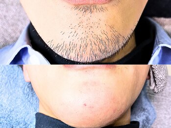 リムーブ(ReMove)の写真/しぶといヒゲや白髪もスッキリ!一人一人に合わせた丁寧なケアで清潔感を手に入れましょう☆