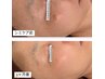 【レーザーが怖い方へ】本気のシミ改善│70分18,000円→12,000円