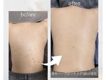 ルーム(lume)/背中ハーブピーリング3回施術
