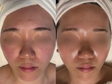 TEN Aesthetic【艶肌・肌質改善・五臓漢方よもぎ蒸し】【7/2　NEW　OPEN（予定）】/ニキビのお悩みお任せください！