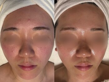 TEN Aesthetic【艶肌・肌質改善・五臓漢方よもぎ蒸し】【7/2　NEW　OPEN（予定）】/ニキビのお悩みお任せください！