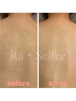 ラ セルフィー(Ra Selfee)/背中の産毛もキレイに♪