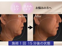 クオンタム(Quantum)の雰囲気（しわ・たるみ・シミ・くすみ・肌荒れなどのお悩みをケアします♪）