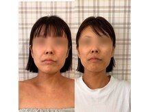 エヤム(eyam)の雰囲気（（40代）左Before1回目　右After7回目）