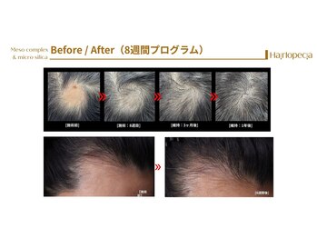 サロン プリーヴィ ドゥブルヴェ(SALON PRIVE W)/隠さない!8週間育毛促進モニター