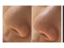 ビボーン ボディ(美bone body)/毛穴エクストラクション