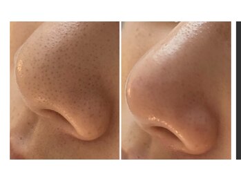 ビボーン ボディ(美bone body)/毛穴エクストラクション