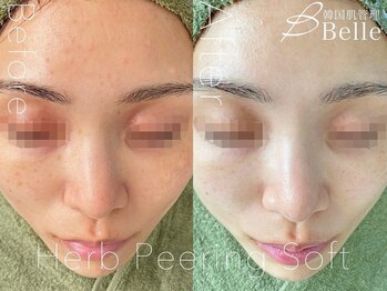 ベル 目黒(Belle)/ハーブピーリング|ニキビケア