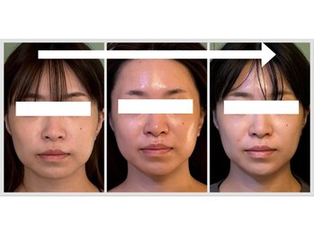 グロウズ(Glows)/小顔&たるみ改善