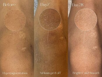 ヨウン 大阪心斎橋(yeoun)/ローマピンク大阪/メラニンケア