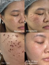 トータルビューティーサロン ルース(LUZ)/【ホワイトラボでシミケア♪】