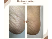 フットケアも得意です♪