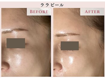 レクラ バイ ドクターエイチ(L'ECLAT by Doctor.H)/ララピール