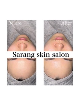 Sarang skin salon/川西｜毛穴洗浄