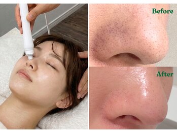 エルフ(elf)の写真/毛穴汚れごっそり！【韓国式♪3D毛穴洗浄体験★¥5500】黒ずみ・角栓を浮かせて吸引♪圧倒的な変化に自信！