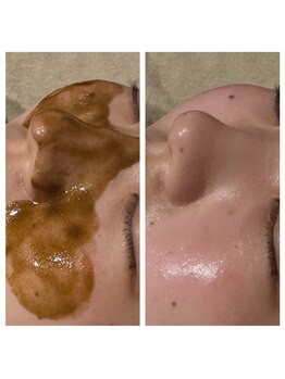ラブロサロンの写真/毛穴ざらつきをケア!剥離なしハーブピーリングで速攻ツヤ肌☆くすみニキビしみも整え透明感ある素肌へ!