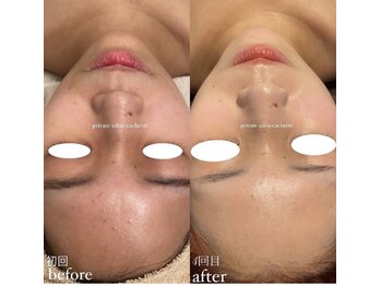 カシェット(cachette)/マグネットパックフェイシャル