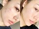 ステラ(Stella)の写真/毛穴の黒ずみや小じわに悩むあなたへ、韓国式ハーブピーリングで透明感あふれる肌を手に入れましょう◎