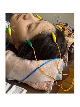 爽健美/電気を流す美容鍼