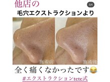 アイシェリー(eyecherie)/毛穴エクストラクション