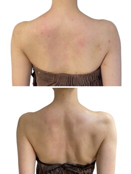 痩せラボ/引き締め【ブライダル】