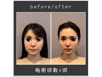 サロン ド ハーモニー美/コルギ♪小顔エラ改善・額丸く等