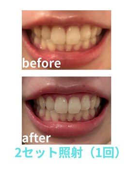 ヴィヴァーチェ(VIVACE)/ホワイトニングビフォーアフター