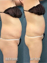 ビーホープ(B.hope)/30代モニター様２回目の変化