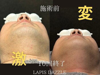 ラピスダズル(LAPIS DAZZLE)/ヒゲ脱毛★途中経過