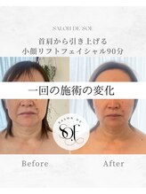 サロンドソエ(Salon de Soe)/小顔フェイシャルでリフトアップ