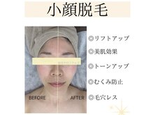 アルゴ 太田店(ALGO)の雰囲気（脱毛しながら【小顔×美肌×毛穴ケア】が叶うサロンはALGOだけ！）