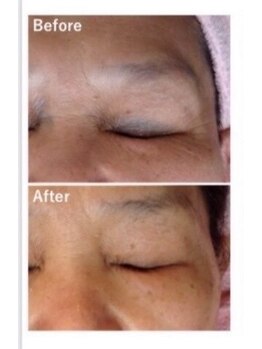 サロン リーナ 北千住店(Salon Lena)/国産★剥けないハーブピーリング