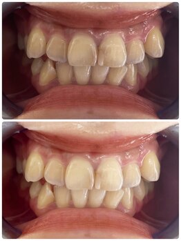 グロウ 東区香椎(GLOW)/美容ホワイトニング