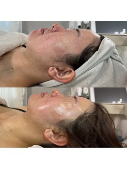 ルアンビューティー メディカルプラス(Luan beauty MEDICAL+)/【ビフォアフ】チタニウムリフト