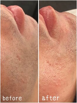 クーレ(CURE)/顔脱毛ビフォーアフター！