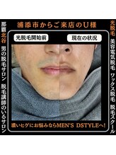 メンズディースタイル 北谷店(Men's Dstyle)/那覇メンズ脱毛 Before After