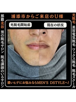 ディースタイル 北谷店(Dstyle)/那覇メンズ脱毛 Before After