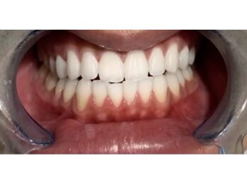 ライトビューティー 恵比寿店(LightBeauty)/☆プレミアムホワイトニング☆