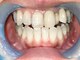 センテレオ(centelleo)の写真/30分でホワイトニング完了◎お仕事の間のスキマ時間も有効活用♪短時間でキレイな歯を目指しませんか？