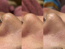 ビヨンド リンク(BEYOND L'INK)/韓国式3D毛穴洗浄