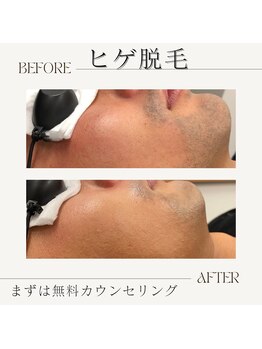エアリアル 武雄店/大人気ヒゲ脱毛!