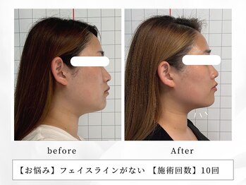 レッド(RED)/顎下のお肉を撃退、V字輪郭形成