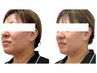 【韓国美容】脂肪分解　ほほのたるみ・二重あご・小顔   22000→16500