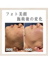 エンルーチェ(enluce)/【天六・梅田】シミケア