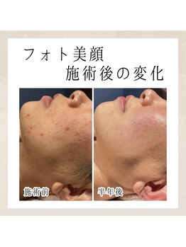 エンルーチェ(enluce)/【天六・梅田】シミケア