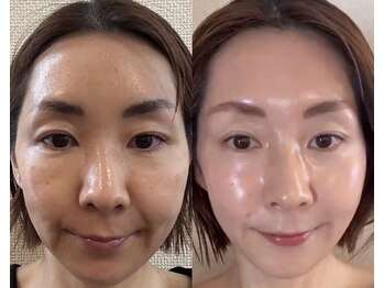 リュクシー(LuxeY)/インセルダム7日間使用