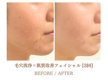 フルハウス エアリアル(Full House AeriAl)/毛穴洗浄×肌質改善フェイシャル