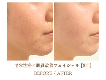 フルハウス エアリアル(Full House AeriAl)/毛穴洗浄×肌質改善フェイシャル