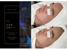 オーヴォ リビングスパ アネックス マノン(OVO LIVING SPA annex MANON)/【施術事例】思春期皮脂ケア