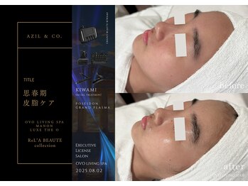 オーヴォ リビングスパ アネックス マノン(OVO LIVING SPA annex MANON)/【施術事例】思春期皮脂ケア